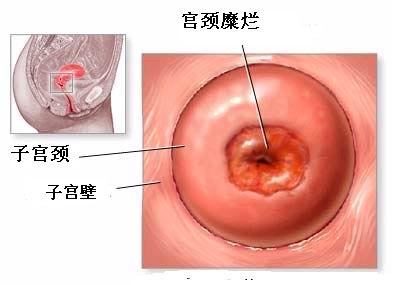宫颈糜烂症状,宫颈糜烂