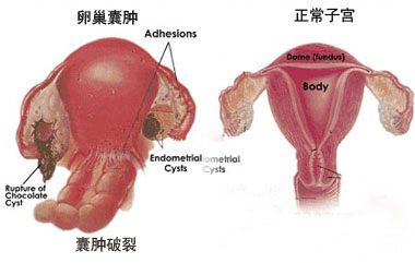 卵巢囊肿